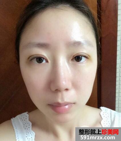 北京八大处整容医院双眼皮手术真实案例和整形价格表