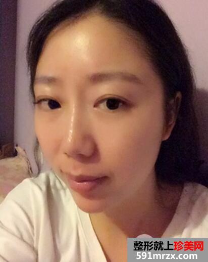 北京八大处整容医院双眼皮手术真实案例和整形价格表