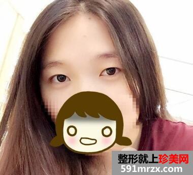 上海九院美容整形外科割双眼皮价格表和案例图片