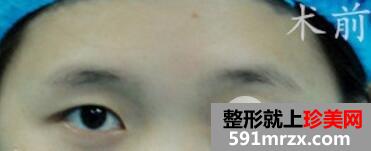 上海九院美容整形外科割双眼皮价格表和案例图片