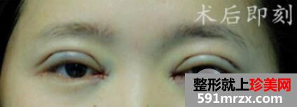 上海九院美容整形外科割双眼皮价格表和案例图片
