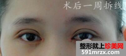 上海九院美容整形外科割双眼皮价格表和案例图片