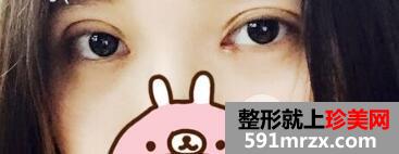 上海九院美容整形外科割双眼皮价格表和案例图片