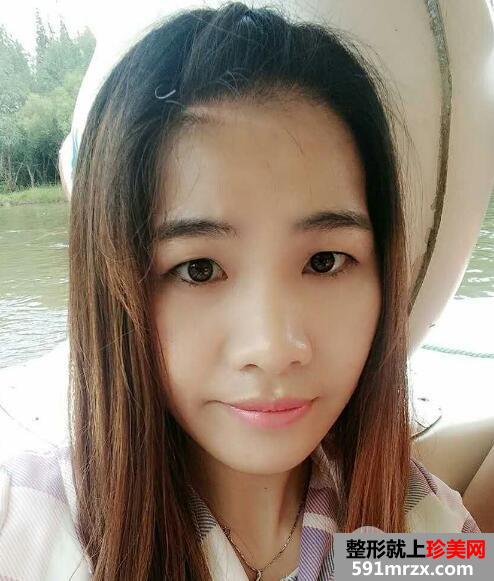 北京丽都美容医院医疗价目表和双眼皮手术案例
