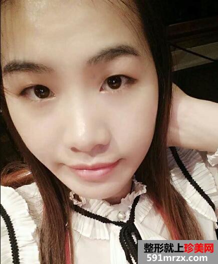 北京丽都美容医院医疗价目表和双眼皮手术案例