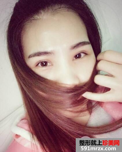 北京丽都美容医院医疗价目表和双眼皮手术案例