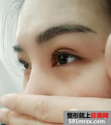 北京丽都美容医院医疗价目表和双眼皮手术案例