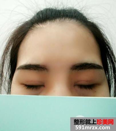 北京丽都美容医院医疗价目表和双眼皮手术案例