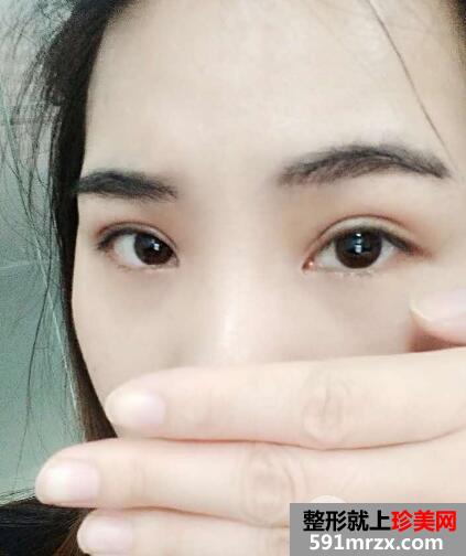 北京丽都美容医院医疗价目表和双眼皮手术案例