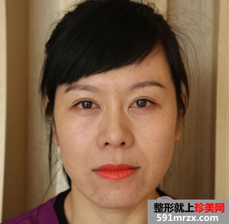 去美莱医院做了面部除皱紧肤埋线提升效果图和价格分享
