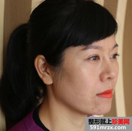 去美莱医院做了面部除皱紧肤埋线提升效果图和价格分享