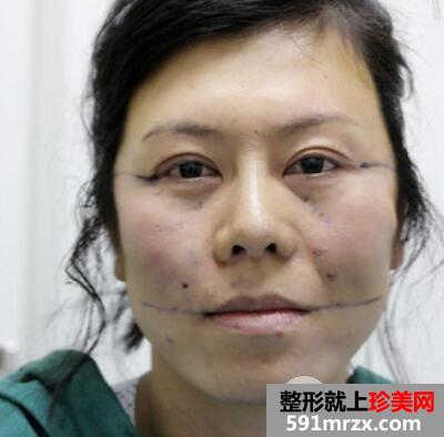 去美莱医院做了面部除皱紧肤埋线提升效果图和价格分享