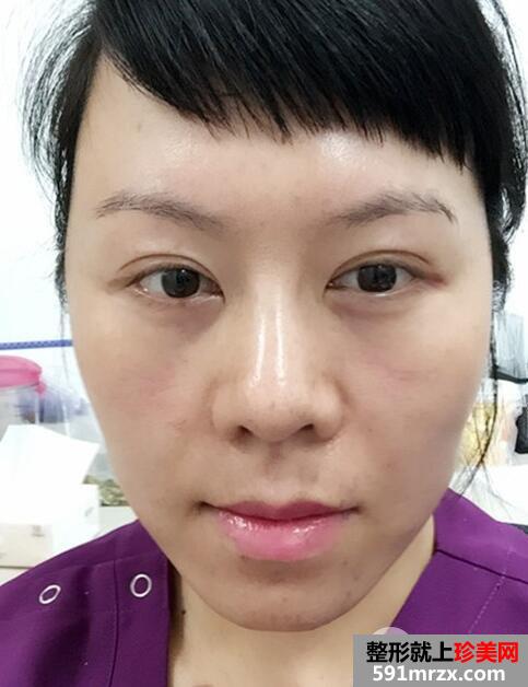 去美莱医院做了面部除皱紧肤埋线提升效果图和价格分享