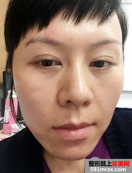 去美莱医院做了面部除皱紧肤埋线提升效果图和价格分享