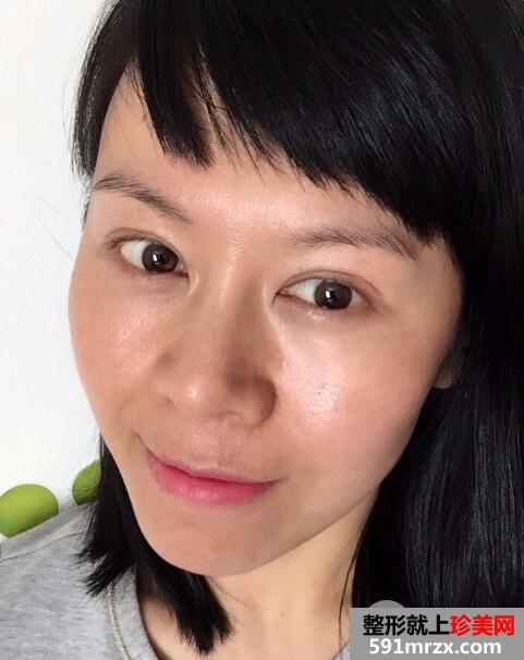 去美莱医院做了面部除皱紧肤埋线提升效果图和价格分享