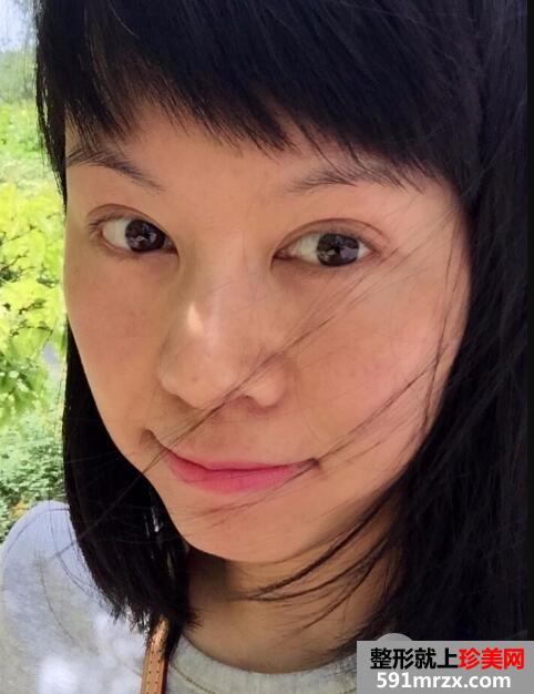 去美莱医院做了面部除皱紧肤埋线提升效果图和价格分享