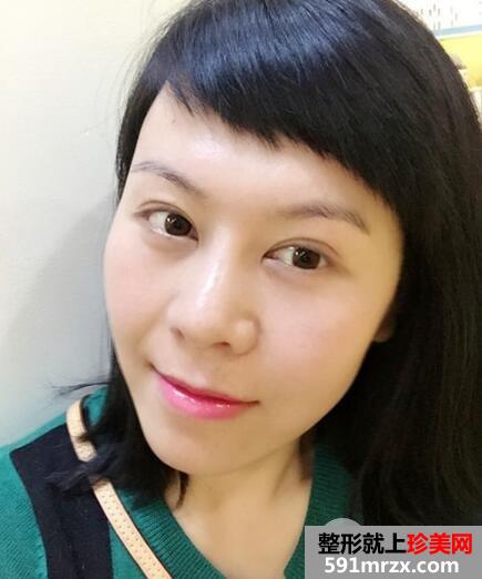 去美莱医院做了面部除皱紧肤埋线提升效果图和价格分享