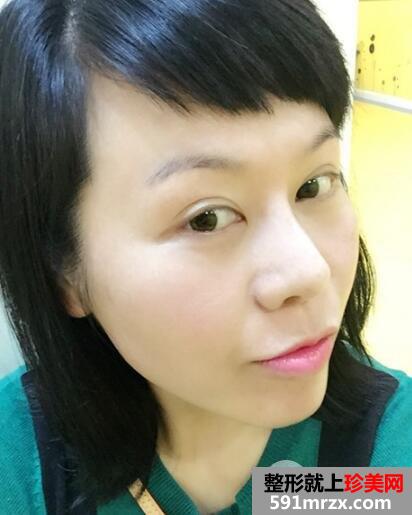 去美莱医院做了面部除皱紧肤埋线提升效果图和价格分享