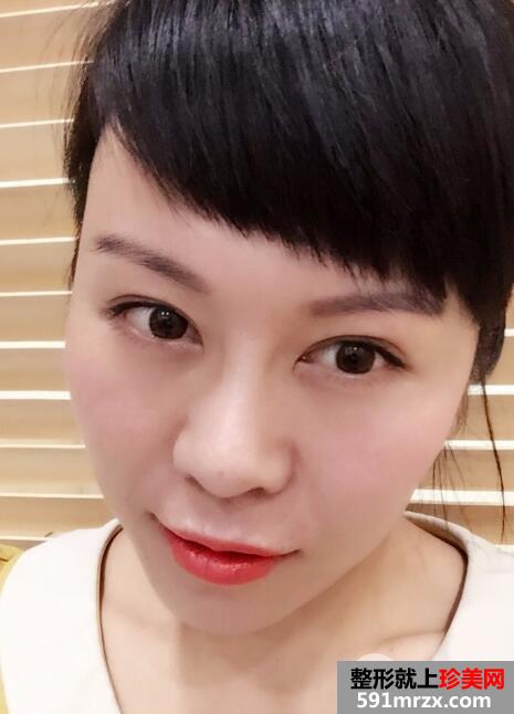 去美莱医院做了面部除皱紧肤埋线提升效果图和价格分享