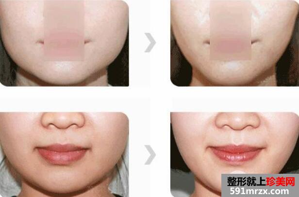 上海华美医疗美容医院靠谱吗？双眼皮微整形价格表