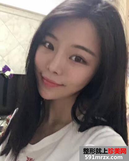 硅胶隆鼻失败后假体取出照片和鼻综合修复案例