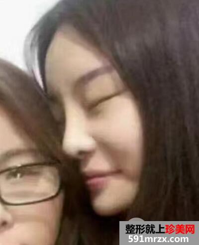 硅胶隆鼻失败后假体取出照片和鼻综合修复案例