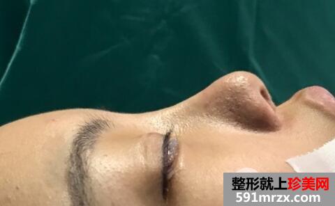 硅胶隆鼻失败后假体取出照片和鼻综合修复案例