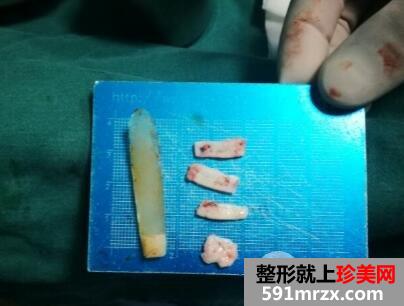 硅胶隆鼻失败后假体取出照片和鼻综合修复案例