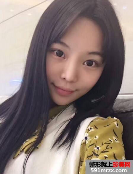 硅胶隆鼻失败后假体取出照片和鼻综合修复案例