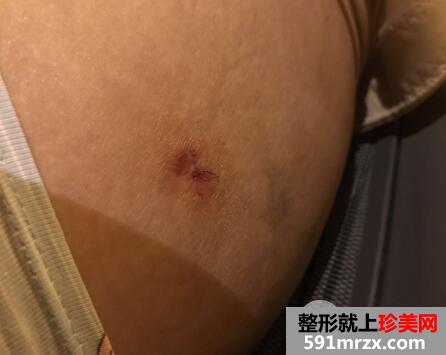 大腿360环形吸脂减肥手术后恢复过程图片案例