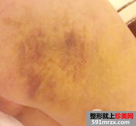 大腿360环形吸脂减肥手术后恢复过程图片案例
