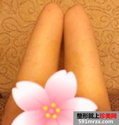大腿360环形吸脂减肥手术后恢复过程图片案例