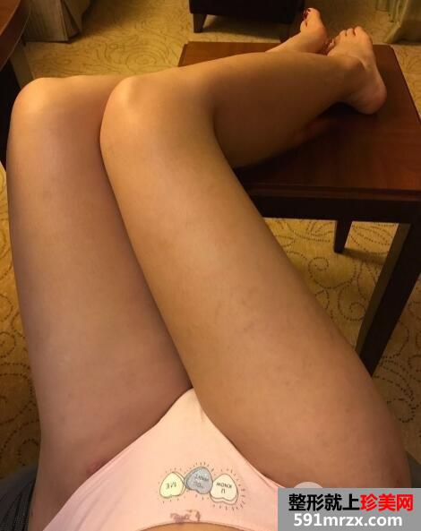 大腿360环形吸脂减肥手术后恢复过程图片案例