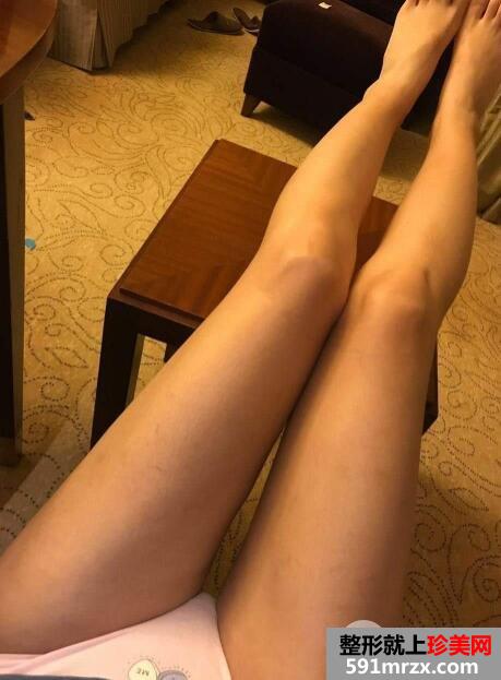 大腿360环形吸脂减肥手术后恢复过程图片案例