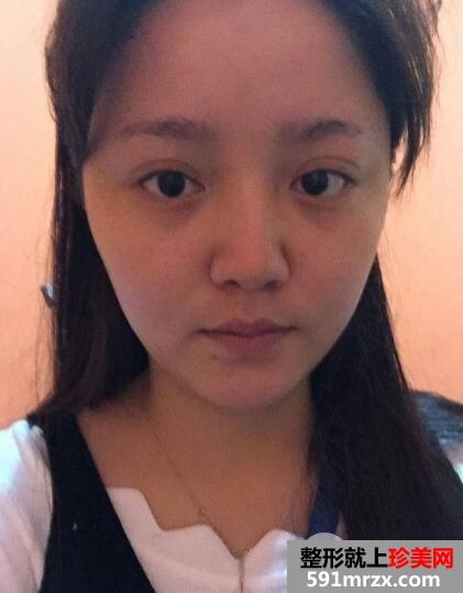 玻尿酸填泪沟前后对比效果图片和案例