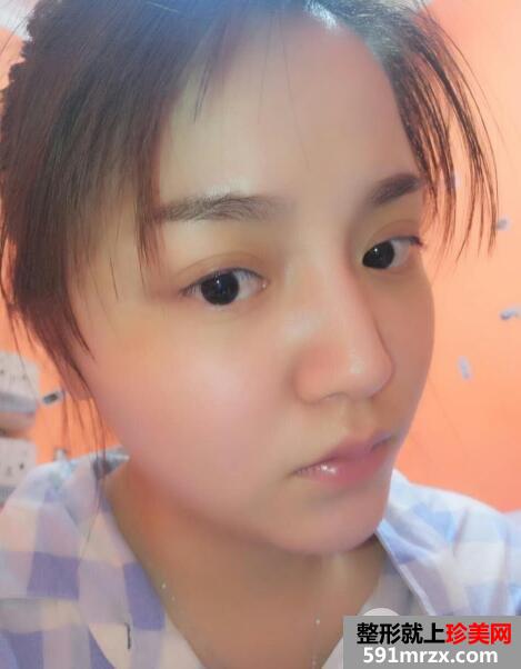 玻尿酸填泪沟前后对比效果图片和案例