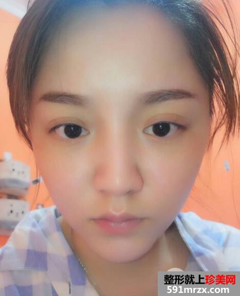 玻尿酸填泪沟前后对比效果图片和案例