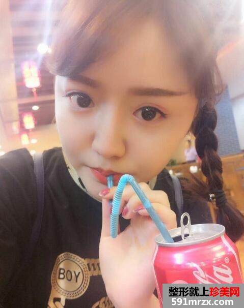 玻尿酸填泪沟前后对比效果图片和案例