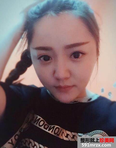 玻尿酸填泪沟前后对比效果图片和案例