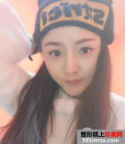 玻尿酸填泪沟前后对比效果图片和案例
