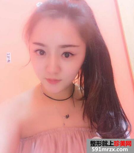 玻尿酸填泪沟前后对比效果图片和案例