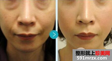 光子嫩肤多少钱一次？一般做几次有效果？