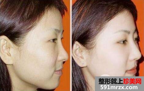 光子嫩肤多少钱一次？一般做几次有效果？