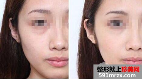 光子嫩肤多少钱一次？一般做几次有效果？