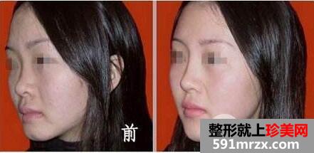 光子嫩肤多少钱一次？一般做几次有效果？