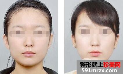 瘦脸针多少钱一次？打几次能定型？