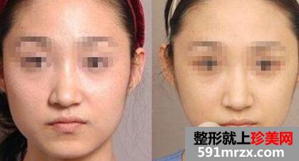 瘦脸针多少钱一次？打几次能定型？
