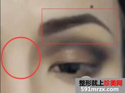 做欧式双眼皮价格和需要满足5个条件效果才好