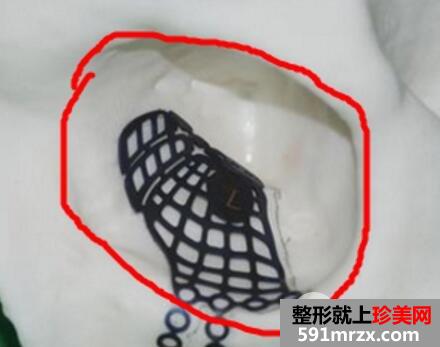 做欧式双眼皮价格和需要满足5个条件效果才好
