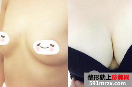 假体隆胸手术价格和案例